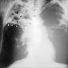 Multi-drug-resistant tuberculosis