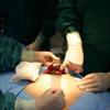 Appendectomy