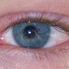 Conjunctivitis