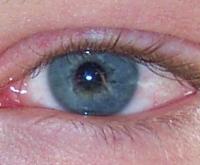 Conjunctivitis