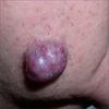 tumor