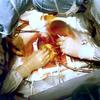cardiac surgery