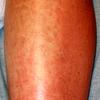 Urticaria