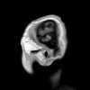 Cerebral aneurysm