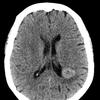 Brain tumor