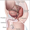 Prostate cancer