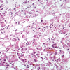Hepatitis