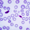 malaria