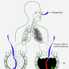 Pneumonia