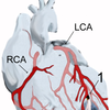 Myocardial infarction