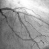 angioplasty