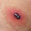 Inflammation