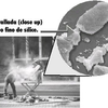 Silicosis