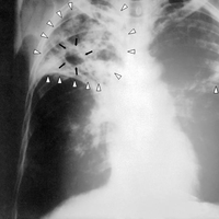 Tuberculosis